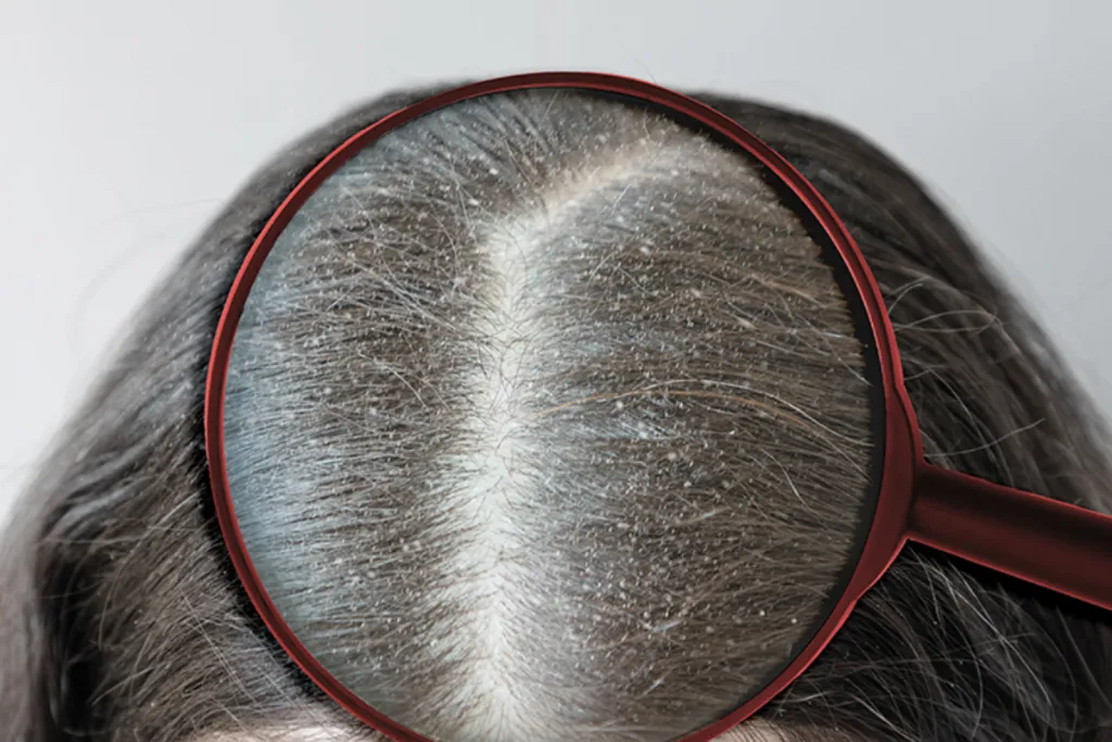 Causes of itchy scalp